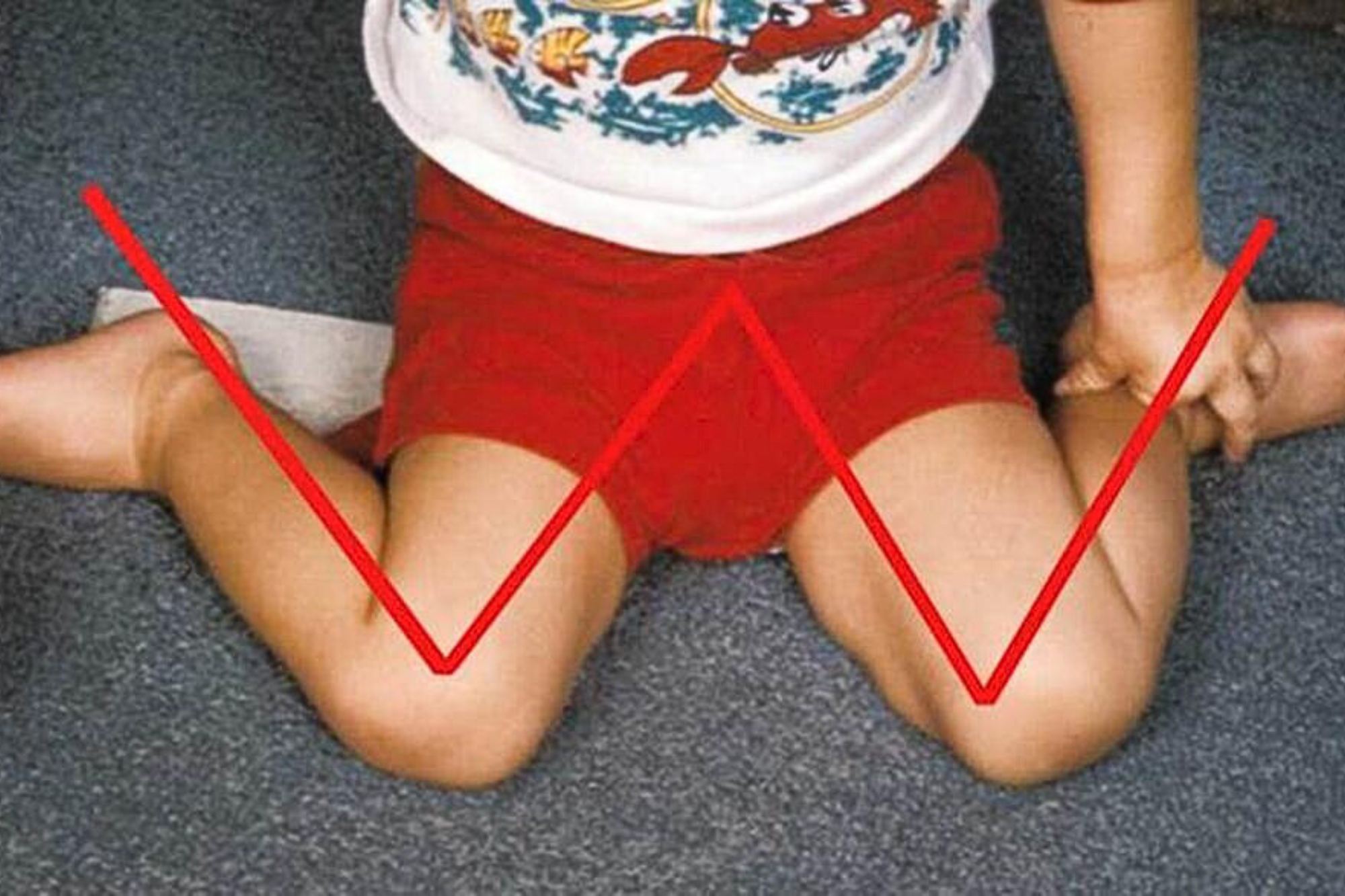 enfant assis dans la posture du W